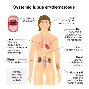 lupus-symptoms