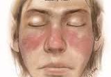 butterfly rash